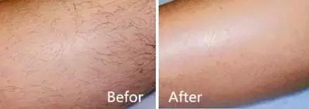 我们有没有为脱毛烦恼过,为了减肥都做过什么事