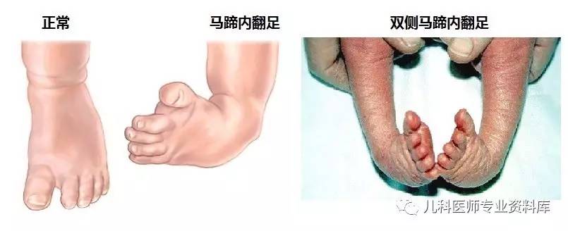 儿童内八字脚穿什么鞋,儿童内八字脚是怎么回事