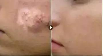 整形医生聊内幕瘦脸针,揭秘医美内幕水光针