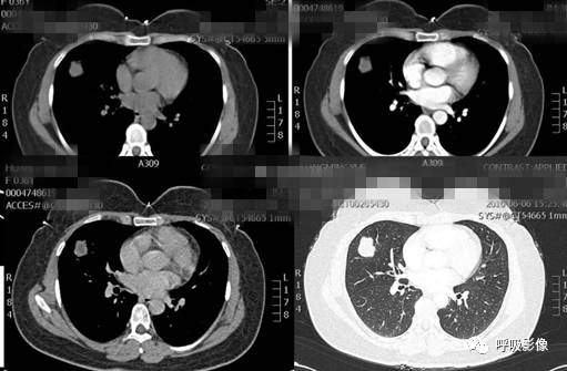 绒毛膜癌转移到脑,绒毛膜癌肺转移