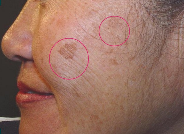 突然长出黑斑怎么去除最有效,以前长的黑斑怎么能去掉