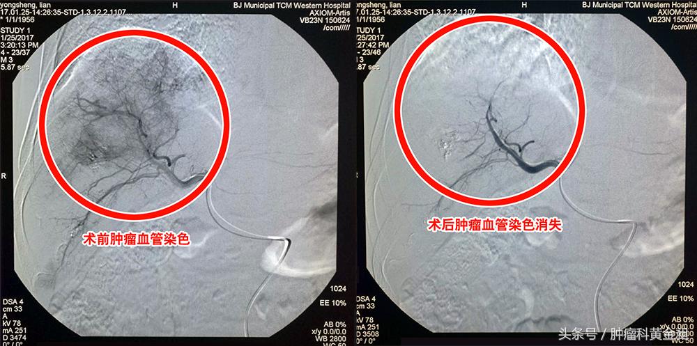 肝癌介入栓塞化疗的副作用,肿瘤介入手术栓塞血管