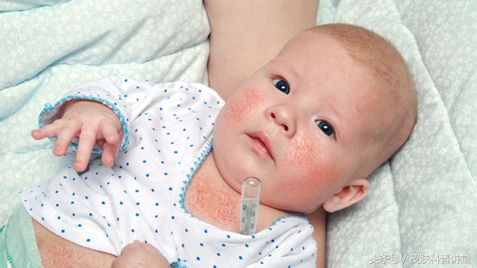 如何辨别儿童猩红热,儿童猩红热的症状与表现