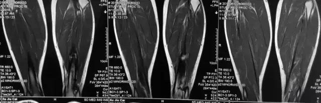 骨折内固定伤口处流脓是为什么,骨折固定支架外部流脓怎么处理