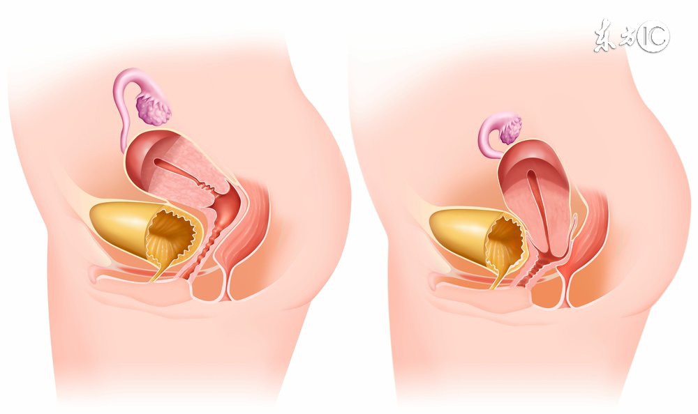 想到那位在家等死的宫颈癌患者,我就痛心不已癌症并不那么可怕