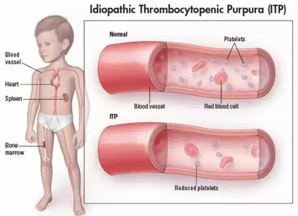 血小板减少性紫癜是大病吗好治吗,血小板减少紫癜是什么病能治好吗