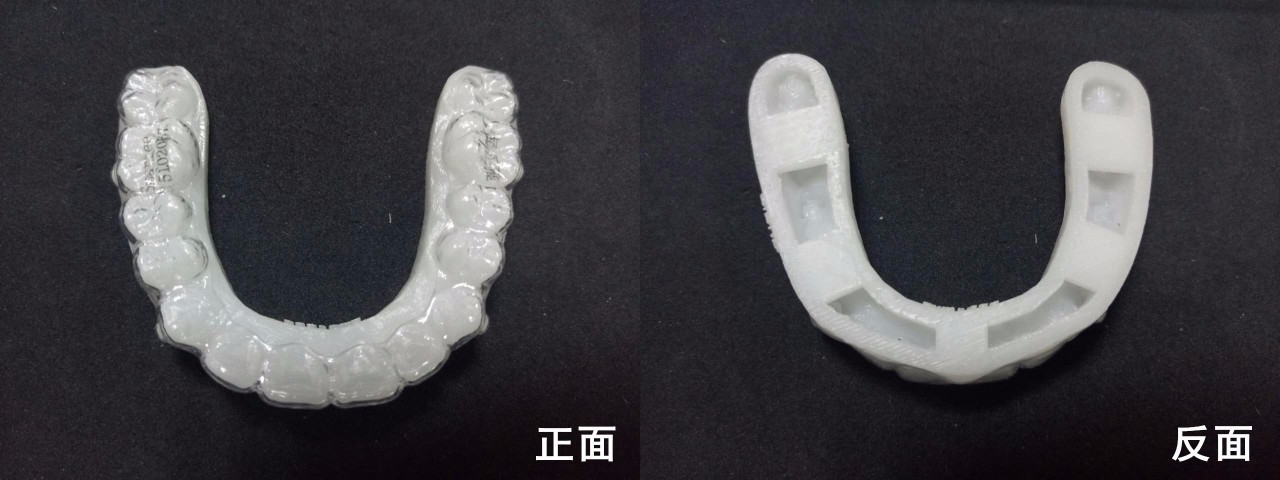 隐形牙套整牙全过程介绍,拔掉四颗牙隐形牙套矫正的全过程