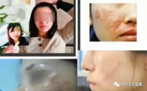 超声刀抗衰老效果,超声波抗衰美容效果怎么样