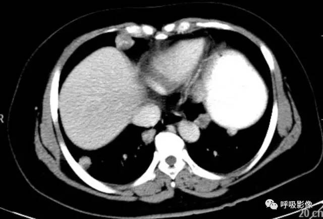 绒毛膜癌转移到脑,绒毛膜癌肺转移
