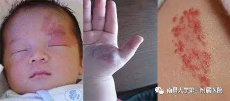 哪些胎记有危险,宝宝胎记是什么原因造成的