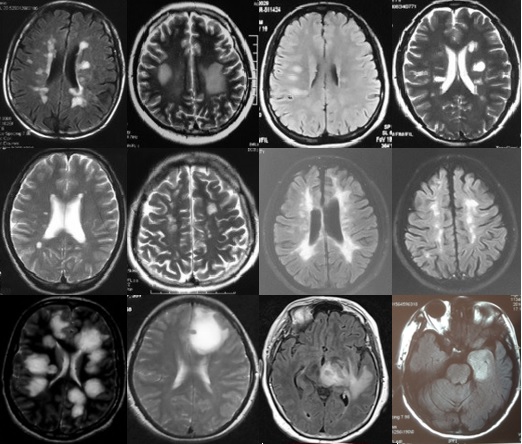 中枢神经脱髓鞘病是重大疾病吗,中枢神经系统脱髓鞘和多发性硬化