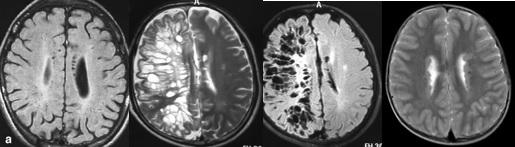 中枢神经脱髓鞘病是重大疾病吗,中枢神经系统脱髓鞘和多发性硬化
