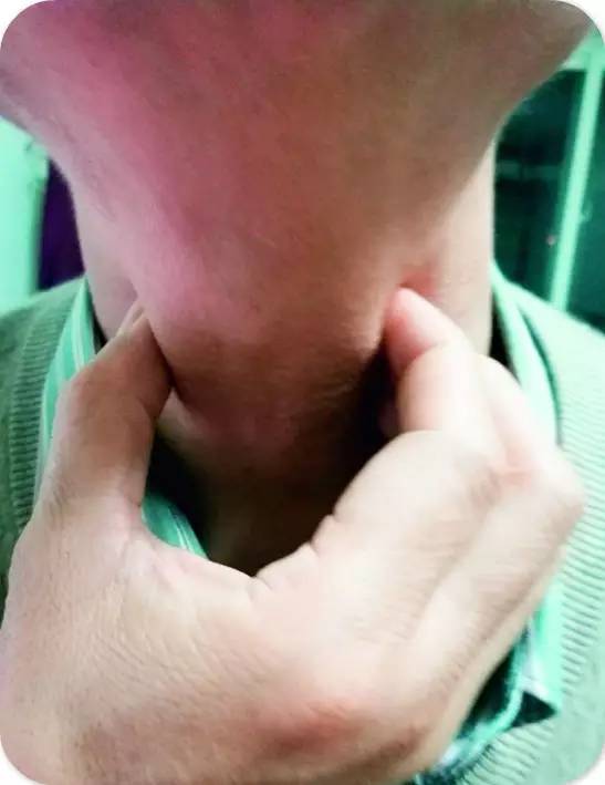 慢性咽炎按哪里可以缓解,慢性咽炎按哪个穴位特有效