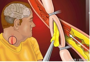 哪些人是动脉粥样硬化的高危人群,动脉粥样硬化该怎样预防和治疗