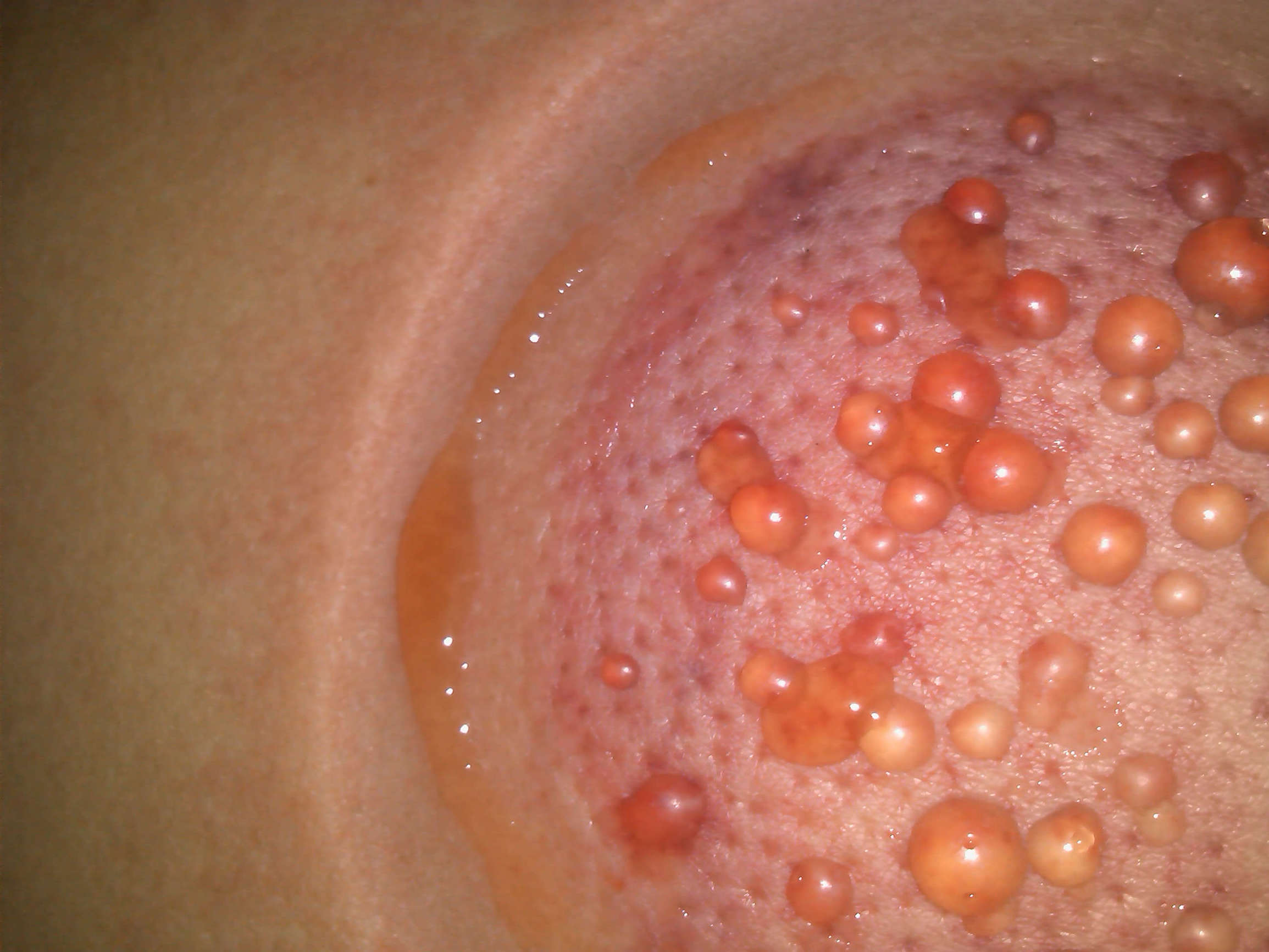 拔罐的危害到底有多可怕,拔罐后千万不要做这3件事