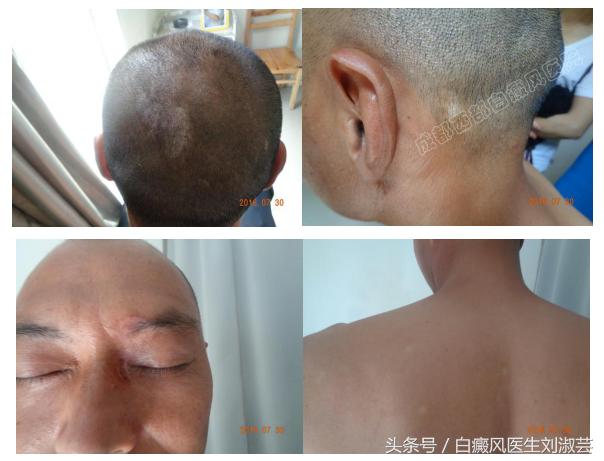 得了白质病要怎么治疗,患白