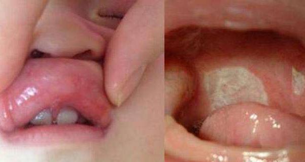 宝宝嘴巴里面有缺口,宝宝嘴巴有一道裂缝