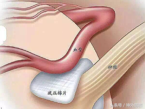 肉毒素真的可以缓解面部痉挛吗,肉毒素治疗眼睑痉挛导致眼睁不开