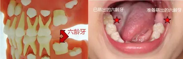 恒牙换牙不,恒牙不长出