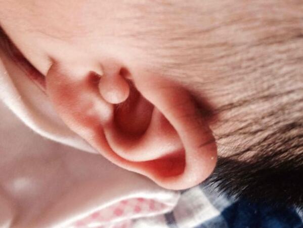 宝宝耳边有个小鼓包软软的,宝宝耳边长了个包