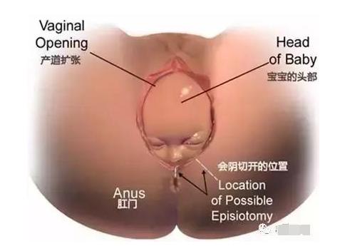顺产下面撕裂缝合的线不拆可以吗,顺产剪一刀需要缝吗