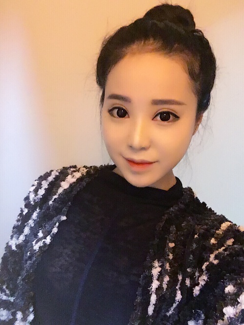 全切双眼皮疤痕增生多久可以恢复,全切双眼皮恢复过程经历真实