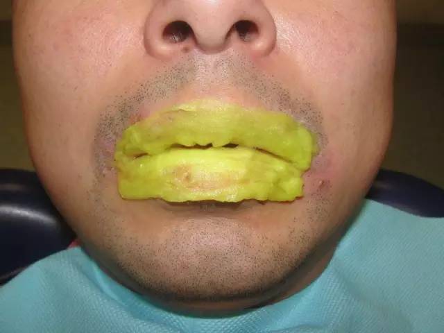 上火引起嘴唇干裂起皮用啥药,因为上火嘴唇起皮吃什么药