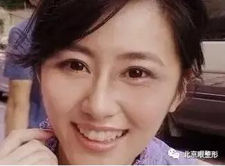 鱼尾纹，这样除最简单，一针即刻见效！