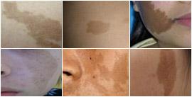 咖啡斑胎记怎么食疗淡化,淡化咖啡斑食谱