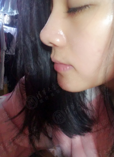 打了水光针,打了一年的水光针