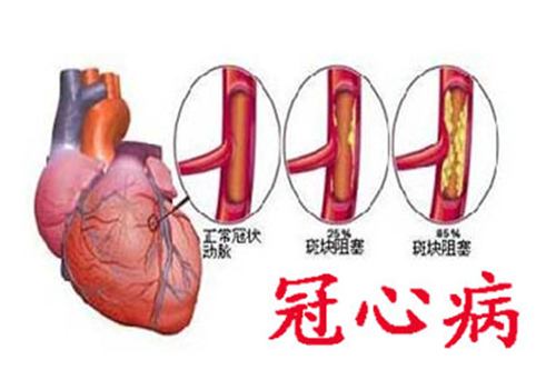 绐佸彂鍐犲績鐥呭拰鐥涚粡鏈夊叧绯诲悧,鍐犲績鐥呭悗鍑虹幇鐥涚粡