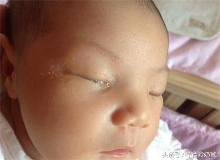 新生儿眼屎多且黄还粘稠的原因,新生儿眼屎多又黄又浓稠怎么解决