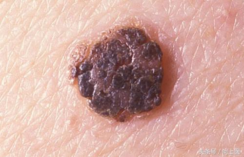 图解成年人常见的皮肤问题