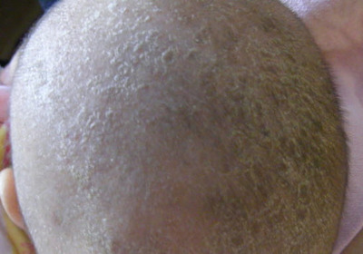 新生儿头垢需要处理吗,新生儿头痂怎么洗