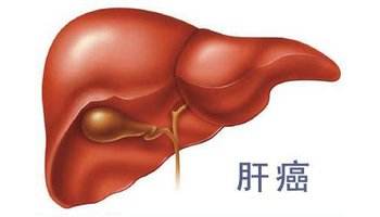 名老中医治疗肝癌医案,原发性肝癌预后判断