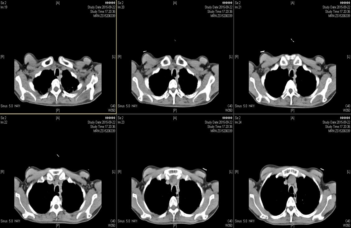 反复咳嗽咳痰气喘5年,长期咳嗽气短久治不愈的原因
