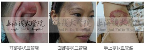 治疗血管瘤的最好医生,郭先锋谈血管瘤饮食禁忌