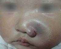 海绵状血管瘤如何正确护理?