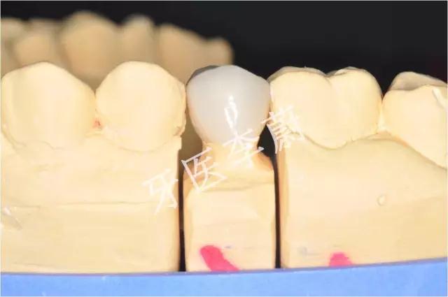 前牙残根桩冠修复,前磨牙嵌体修复