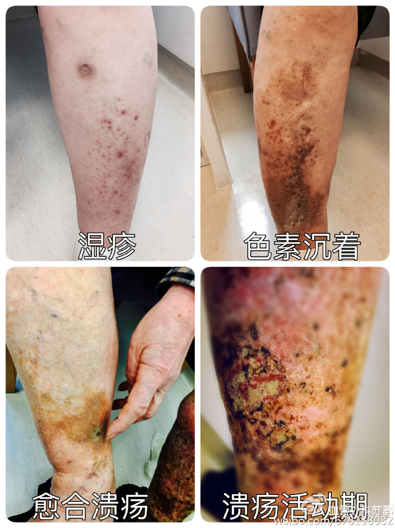 静脉曲张引发溃疡怎么治疗,如何治疗静脉曲张引起的溃疡