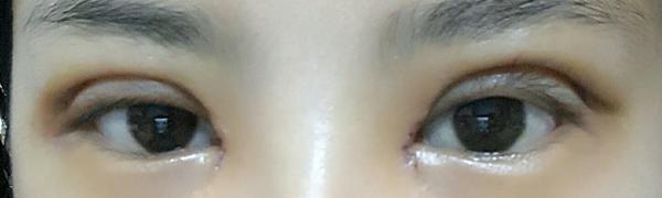 全切双眼皮15天,恢复的差不多了