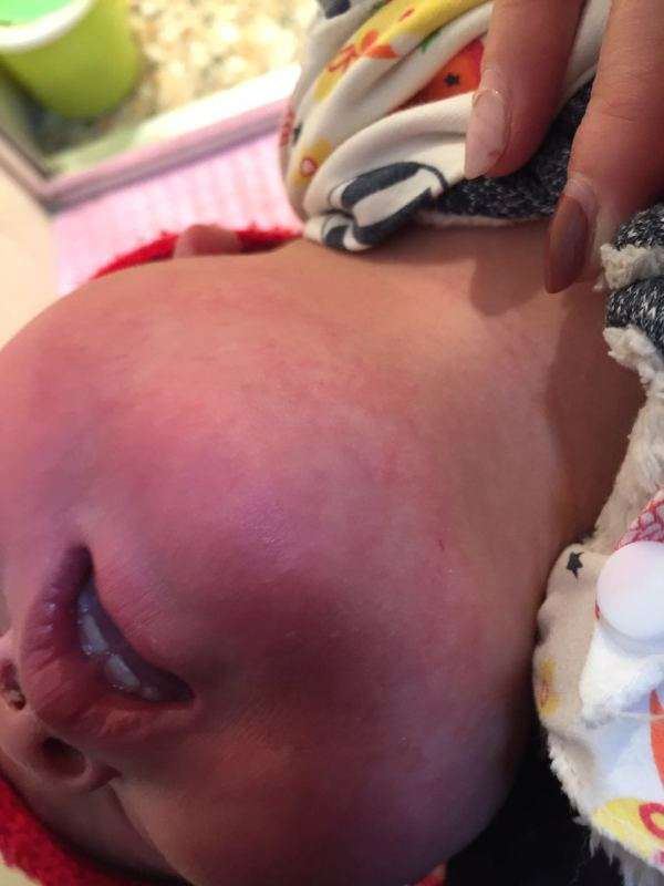 如何根治宝宝反复发作的湿疹问题,宝宝得了湿疹的最佳治疗方法