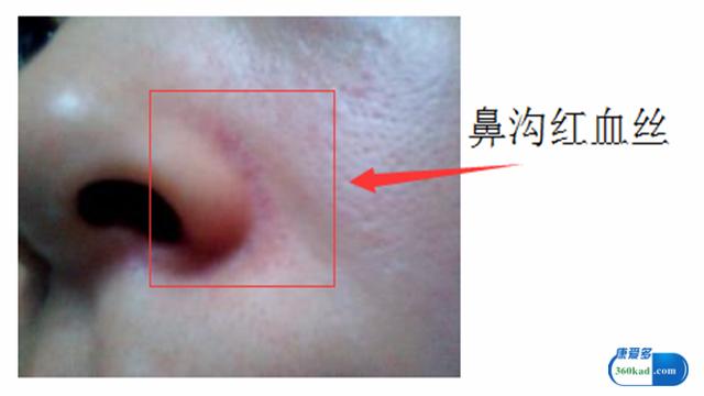 鼻子两侧有红血丝是什么原因,鼻子两边有红血丝有什么办法