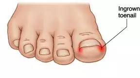 大脚趾甲有点轻微的嵌甲怎么处理,嵌甲手术后指甲还能恢复原样吗