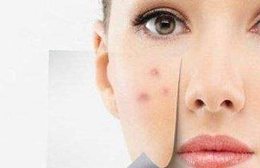 收缩毛孔最好的产品,什么药可以收缩毛孔