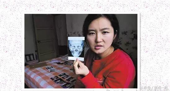 垫下巴之后感觉嘴扁,垫下巴垫歪了能用玻尿酸矫正吗