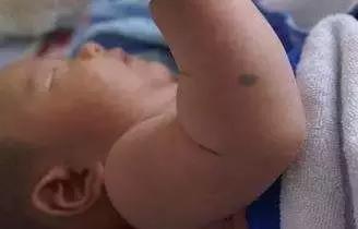 宝宝身上大片青色胎记还有咖啡斑,宝宝身上青色胎记