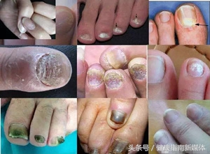 宝宝会得灰指甲什么样子,宝宝指甲像灰指甲怎么办