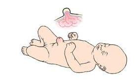 新生儿脐疝如何处理,新生儿脐疝初期怎么处理