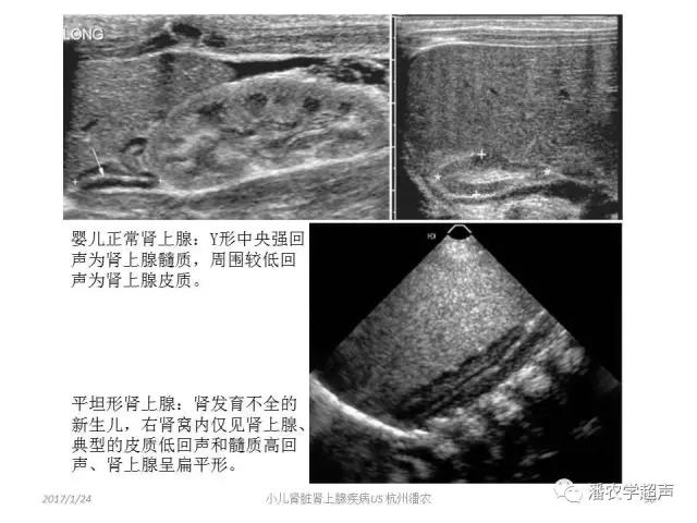 小儿肾上腺囊性占位超声表现,肾上腺疾病的影像学诊断
